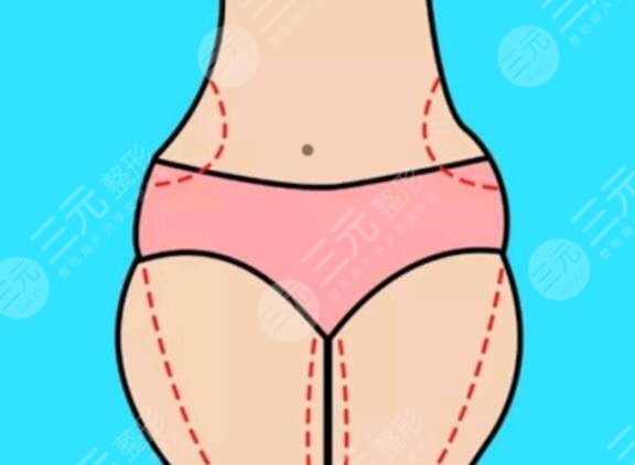 腰腹吸脂