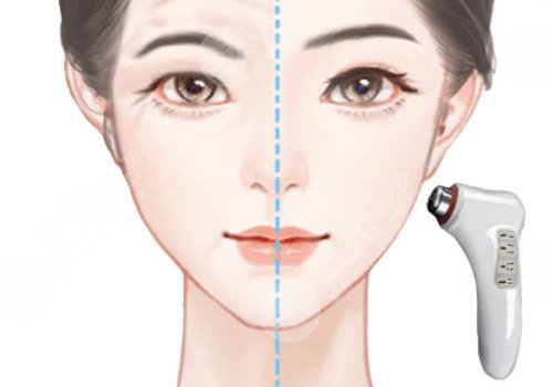 医美超声刀多少钱一次