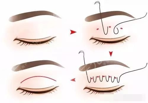 徐州杨琳医生双眼皮案例分享