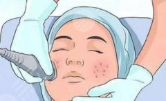 毛孔粗大的医美有哪些？5种方法介绍，细腻嫩肤！