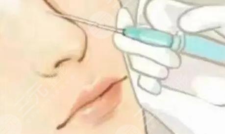 注射隆鼻