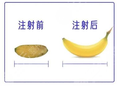 注射增粗手术