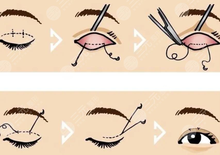  全切双眼皮1个月恢复图