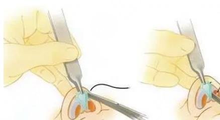 耳软骨隆鼻