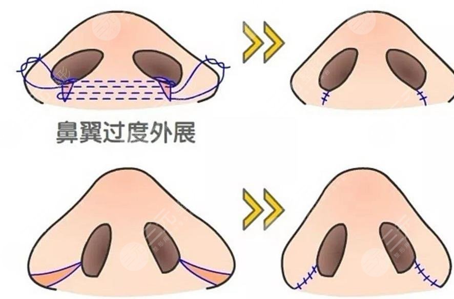 隆鼻
