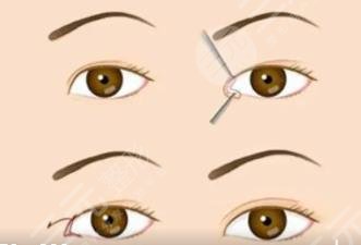 双眼皮修复