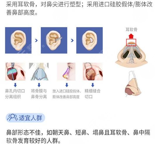 上海自体软骨隆鼻手术价格揭秘！18500元起，指南来了，不花冤枉钱！