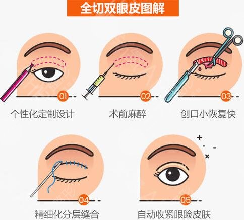 双眼皮