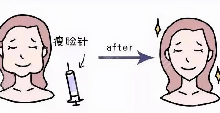 注射瘦脸