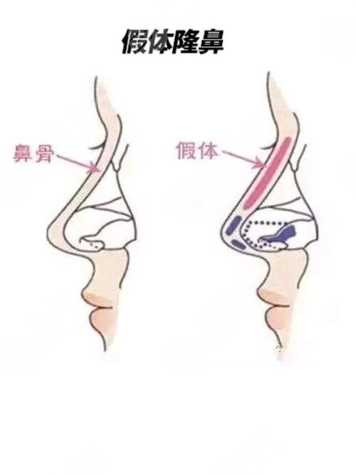 珠江医院蒋萱医生隆鼻案例