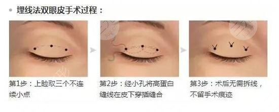 临沂易南方双眼皮案例参考