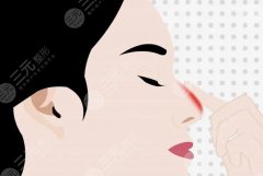 膨体隆鼻好还是硅胶？假体隆鼻指南，材料这样选！