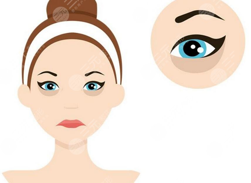 西京医院崔江波医生祛眼袋案例