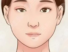 眼综合和全切双眼皮有啥区别？速来看看相关区别在哪