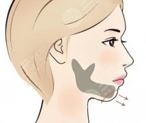 长曲线下颌角和普通下颌角那种好？一一查看两种项目类型