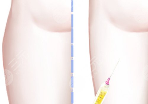 抽脂大腿大约需要多少钱