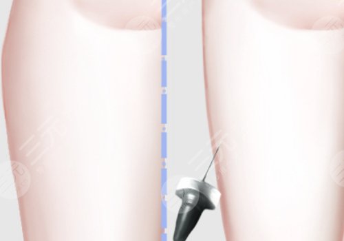 抽脂大腿大约需要多少钱