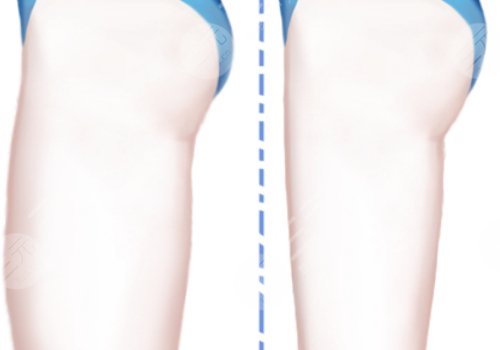 抽脂大腿大约需要多少钱