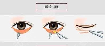 昆明王睿恒医生祛眼袋案例