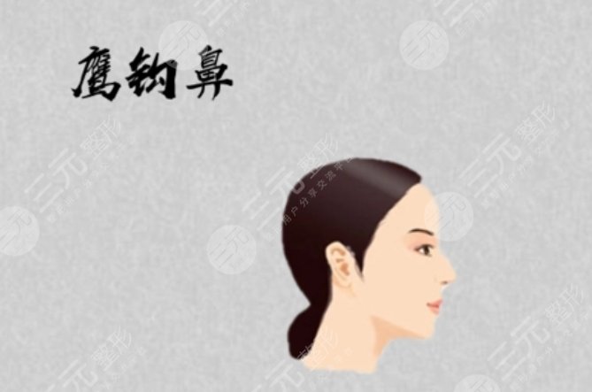 鹰钩鼻子