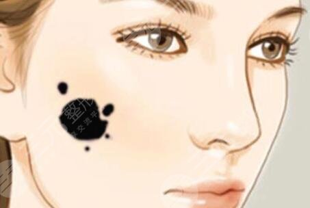 祛痣