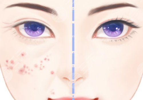 缩小毛孔的医美项目