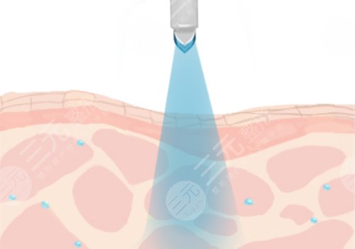 缩小毛孔的医美项目