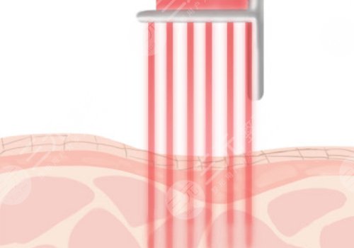 缩小毛孔的医美项目