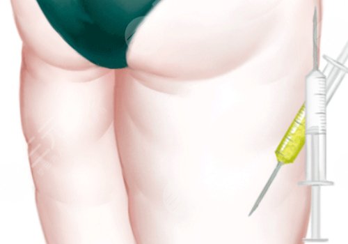 吸脂瘦大腿一般多少钱
