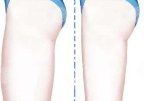 吸脂瘦大腿一般多少钱