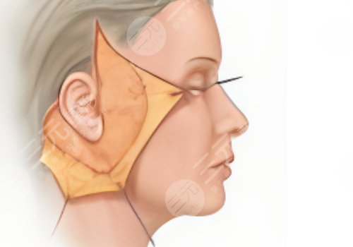 做拉皮手术能保持多少年