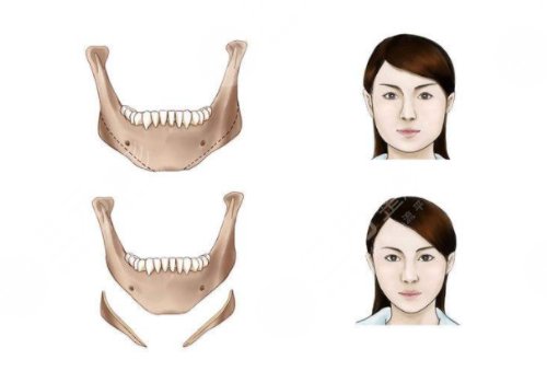 下颌骨整形术一般费用