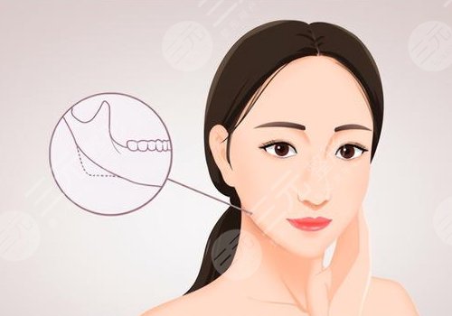 下颌角磨骨手术风险大吗