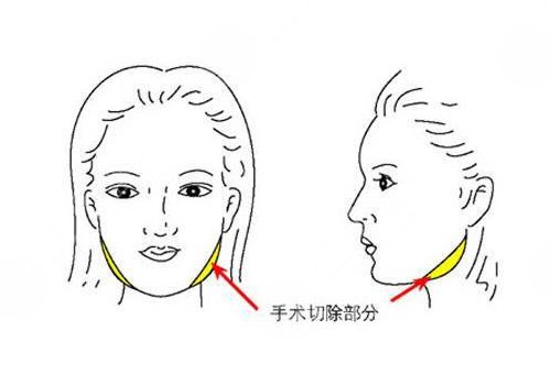 下颌角磨骨手术风险大吗