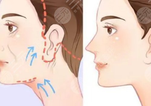面部下垂好的医美手段