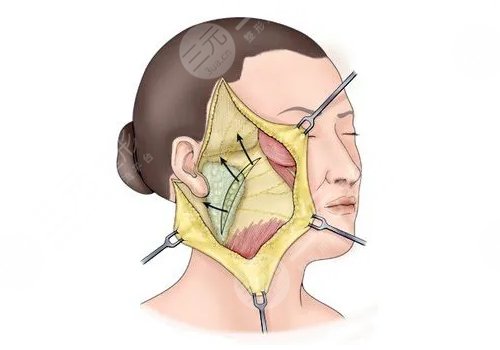 面部下垂好的医美手段