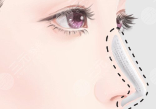 隆鼻想长久建议硅胶还是膨体