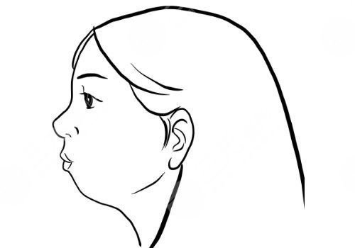 下颌骨后缩怎么矫正