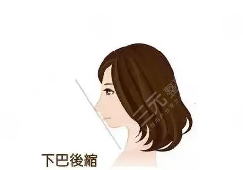 下颌骨后缩怎么矫正