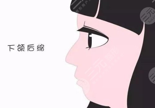 下颌骨后缩怎么矫正