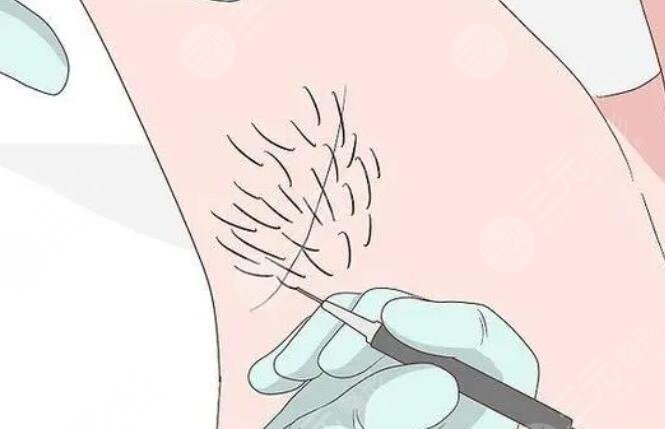 脱腋毛