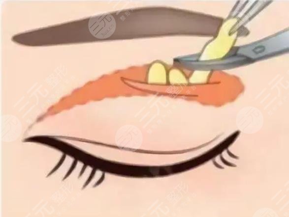 双眼皮
