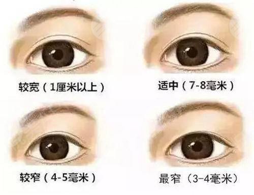 福州吴正思做双眼皮手法