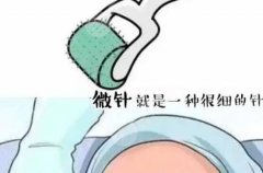 微针的副作用和危害有哪些?美肤别盲目,术前科普告诉你! 微针的副作用和危害有哪些?美肤别盲目,术前科普告诉你!