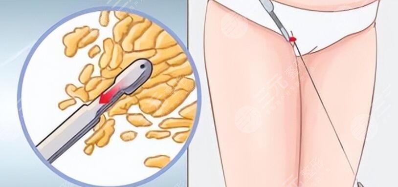 吸脂