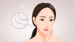 下颌骨一高一低脸歪怎么矫正?手术风险大吗?恢复期多久? 下颌骨一高一低脸歪怎么矫正?手术风险大吗?恢复期多久?