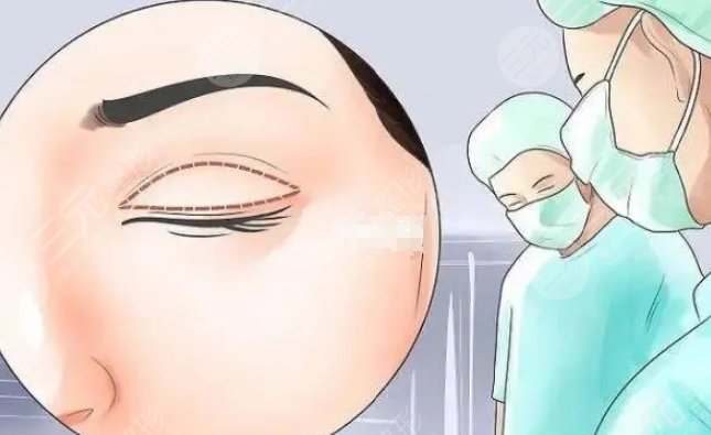 肿眼泡