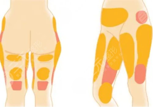 做腿部吸脂的价格需要多少