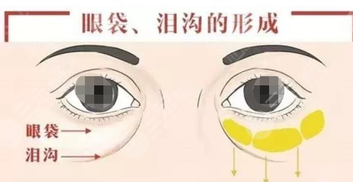 泪沟