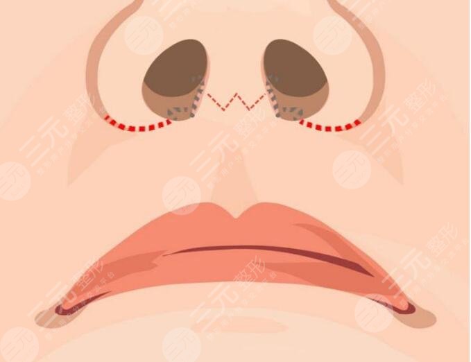 人中窝加深手术